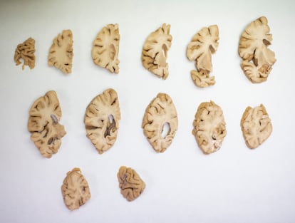 Sections of a dissected human brain at the CIEN Foundation.